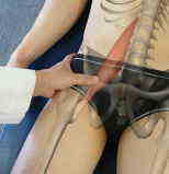 psoas1